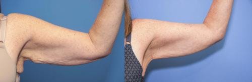 Arm Lift Before & After Gallery - Patient 58172289 - Image 2