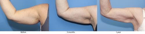 Arm Lift Before & After Gallery - Patient 58172290 - Image 1
