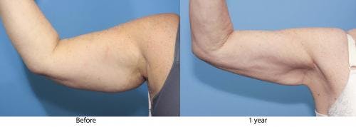 Arm Lift Before & After Gallery - Patient 332524 - Image 2