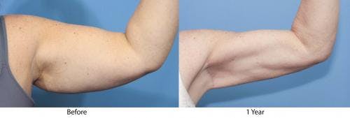 Arm Lift Before & After Gallery - Patient 332524 - Image 3
