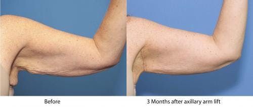 Arm Lift Before & After Gallery - Patient 383481 - Image 1