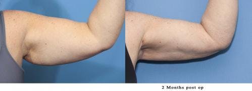 Arm Lift Before & After Gallery - Patient 58172292 - Image 1
