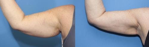 Arm Lift Before & After Gallery - Patient 166768 - Image 2