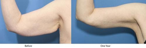 Arm Lift Before & After Gallery - Patient 58172293 - Image 1