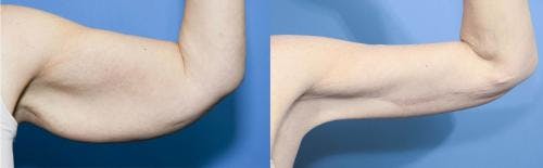 Arm Lift Before & After Gallery - Patient 242979 - Image 1