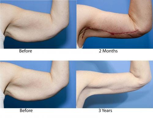 Arm Lift Before & After Gallery - Patient 242979 - Image 2