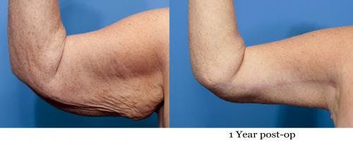 Arm Lift Before & After Gallery - Patient 58172305 - Image 1