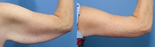 Arm Lift Before & After Gallery - Patient 177658 - Image 1