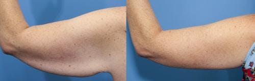 Arm Lift Before & After Gallery - Patient 177658 - Image 2
