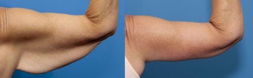 Arm Lift Before & After Gallery - Patient 937594 - Image 1