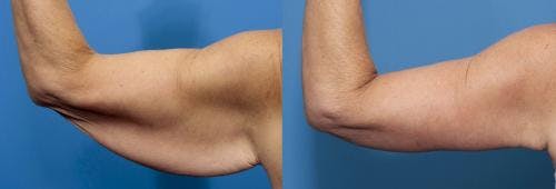 Arm Lift Before & After Gallery - Patient 937594 - Image 2