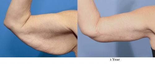 Arm Lift Before & After Gallery - Patient 937594 - Image 3