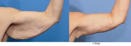 Arm Lift Before & After Gallery - Patient 58172307 - Image 4
