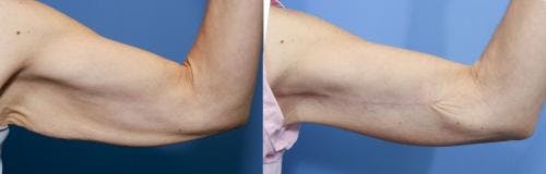Arm Lift Before & After Gallery - Patient 58172314 - Image 1