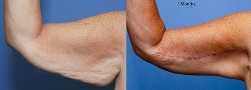 Arm Lift Before & After Gallery - Patient 58172315 - Image 1