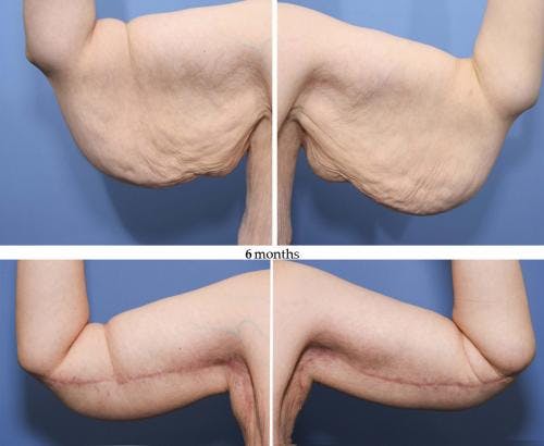 Arm Lift Before & After Gallery - Patient 58172316 - Image 1