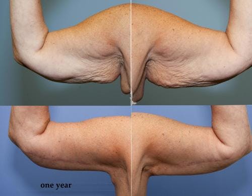 Arm Lift Before & After Gallery - Patient 58172317 - Image 1