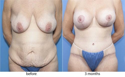 Body Lift Before & After Gallery - Patient 58172320 - Image 1
