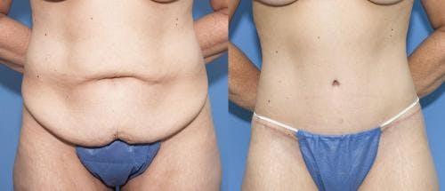 Body Lift Before & After Gallery - Patient 58172321 - Image 1