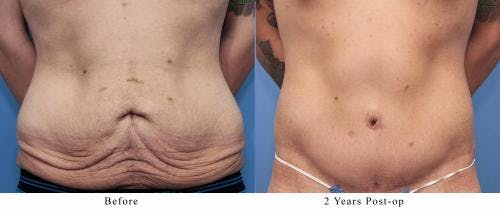 Body Lift Before & After Gallery - Patient 58172323 - Image 1