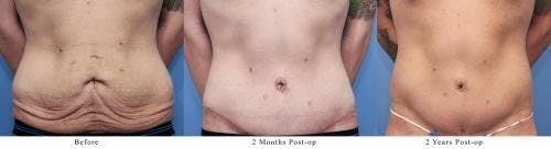 Body Lift Before & After Gallery - Patient 58172323 - Image 2