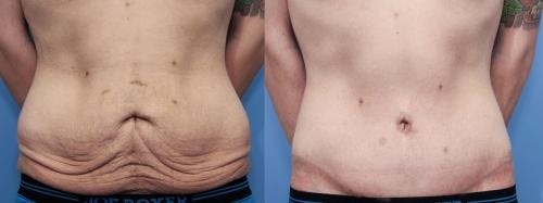 Body Lift Before & After Gallery - Patient 58172323 - Image 3