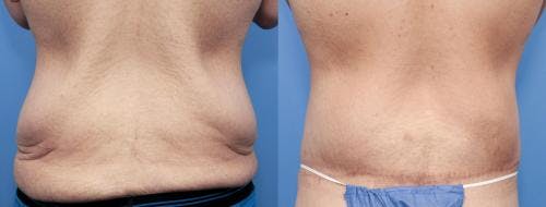 Body Lift Before & After Gallery - Patient 58172323 - Image 4