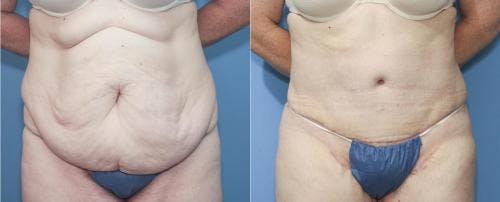 Tummy Tuck Before & After Gallery - Patient 58172324 - Image 1