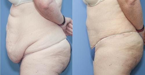 Tummy Tuck Before & After Gallery - Patient 58172324 - Image 2