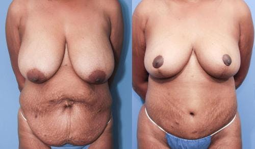 Body Lift Before & After Gallery - Patient 58172325 - Image 1