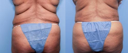Body Contouring After Weightloss