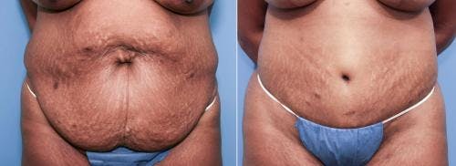 Body Lift Before & After Gallery - Patient 58172325 - Image 3