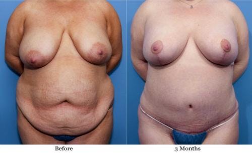 Body Lift Before & After Gallery - Patient 58172326 - Image 1