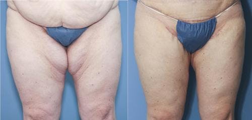 Tummy Tuck Before & After Gallery - Patient 58172327 - Image 3