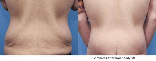 Body Lift Before & After Gallery - Patient 58172329 - Image 1