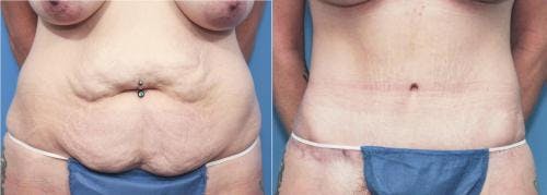 Tummy Tuck Before & After Gallery - Patient 58172328 - Image 1