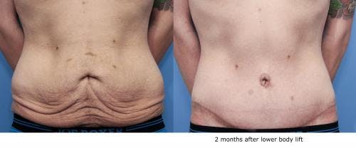 Body Lift Before & After Gallery - Patient 58172329 - Image 2