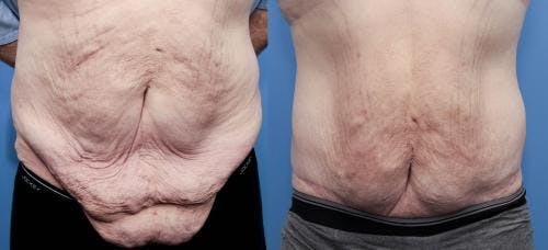 Tummy Tuck Before & After Gallery - Patient 58172331 - Image 1