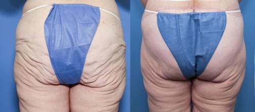 Body Lift Before & After Gallery - Patient 58172330 - Image 1