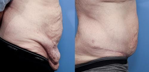 Tummy Tuck Before & After Gallery - Patient 58172331 - Image 2