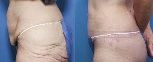 Body Lift Before & After Gallery - Patient 58172330 - Image 2