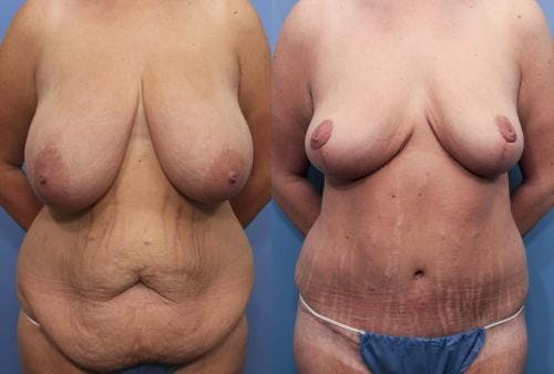 Tummy Tuck Before & After Gallery - Patient 58172333 - Image 1
