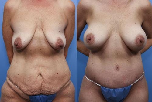 Body Lift Before & After Gallery - Patient 58172334 - Image 1