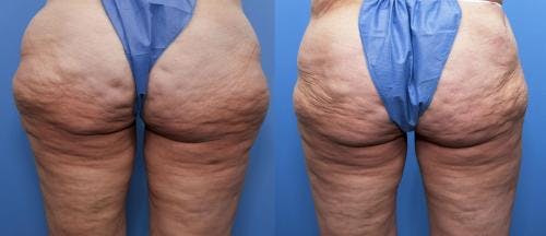Body Lift Before & After Gallery - Patient 58172334 - Image 2