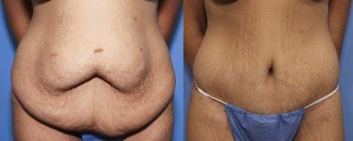 Tummy Tuck Before & After Gallery - Patient 58172335 - Image 1