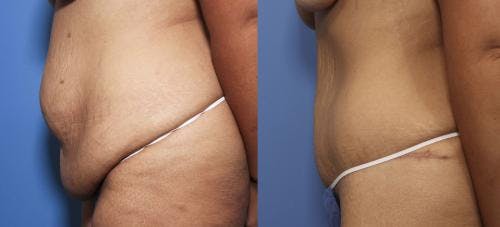 Tummy Tuck Before & After Gallery - Patient 58172335 - Image 2