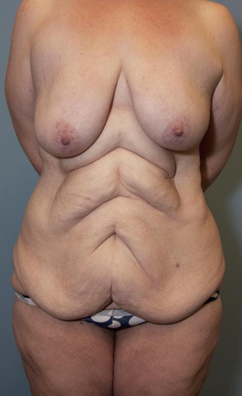 Body Lift Before & After Gallery - Patient 58172336 - Image 1