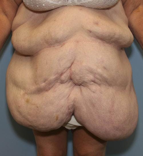 Tummy Tuck Before & After Gallery - Patient 58172337 - Image 1