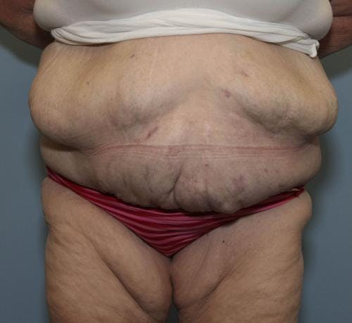 Tummy Tuck Before & After Gallery - Patient 58172337 - Image 2