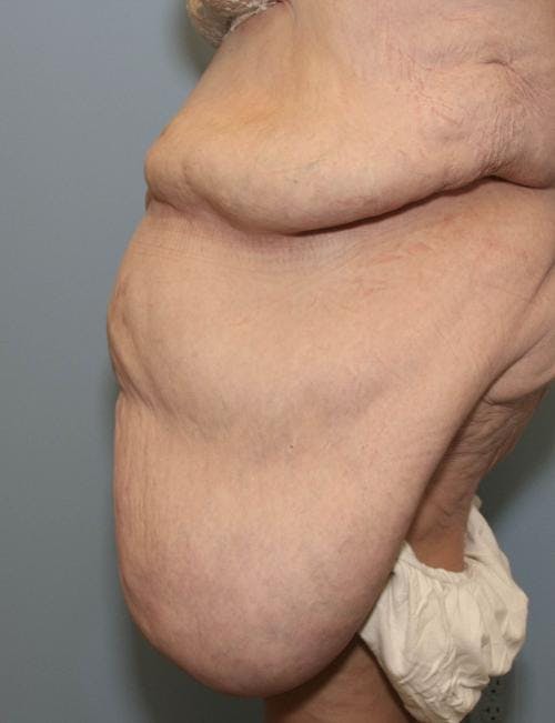 Tummy Tuck Before & After Gallery - Patient 58172337 - Image 3